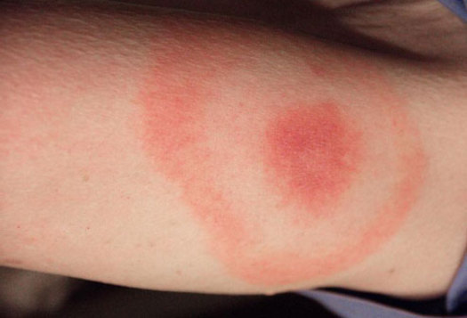 PHOTO: A new National Wildlife Federation report outlines how climate change is connected to a proliferation of outdoor pests, from poison ivy to ticks. Photo of a deer tick reaction associated with lyme disease courtesy of Centers for Disease Control and Prevention. 