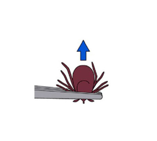 PHOTO: This CDC illustration shows how to safely remove a tick. Lyme disease-transmitting deer ticks have proliferated in Maryland and other states, and a new report from the National Wildlife Federation blames climate change.