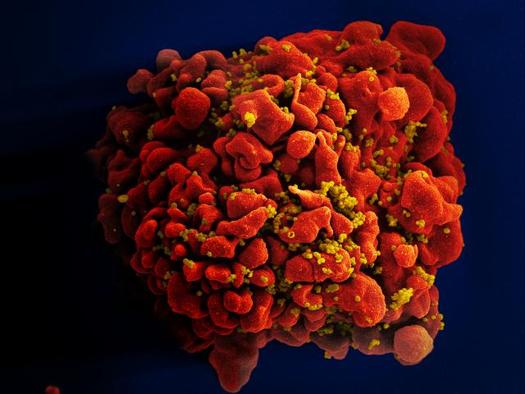 PHOTO: This is a scanning electron micrograph showing an HIV-infected H9 T-cell. Today is World AIDS Day. Photo credit: National Institute of Allergy and Infectious Diseases/Flickr.