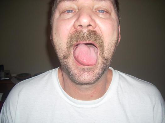 PHOTO: Randy Moyer's tongue is just one of many spots where he says he experiences unexplained pain and swelling after his exposure to fracking waste, made up of a mixture of water and toxic chemicals. Photo courtesy of Moyer.