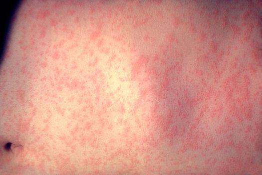 PHOTO: A measles outbreak that began at Disneyland is intensifying the debate over vaccinations. Photo credit: CDC/Dr. Heinz F. Eichenwald.