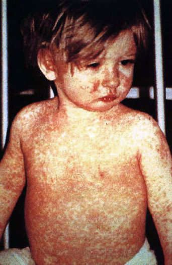 PHOTO: A measles outbreak that began at Disneyland is intensifying the debate over vaccinations. Photo credit: CDC/NIP/Barbara Rice via Wikimedia Commons. 
