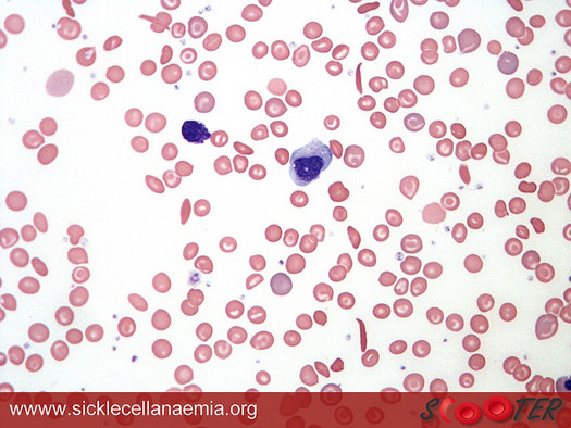 A blood smear of sickle cells that block the body's absorption of oxygen in the bloodstream. (VivCaruna/Flickr)