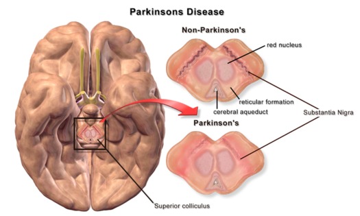 Scientists are close to understanding why some cells that send signals to the body controlling movement are destroyed, which will help in finding a cure for Parkinson's disease. (BruceBlaus/Wikimedia Commons)