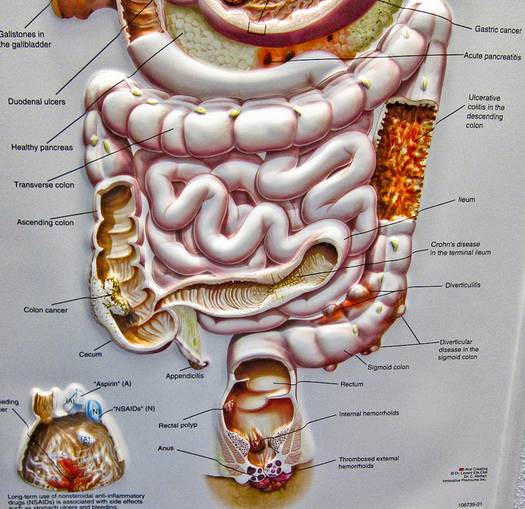 Colorectal cancer is the second and third-leading cause of cancer-related death for men and women, respectively. (Michael (a.k.a. moik) McCullough/Flickr)