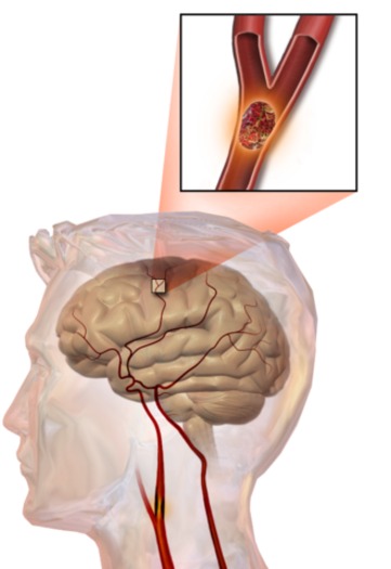 High blood pressure can be an indicator of a person's risk for stroke. (blausen/Wikimedia Commons)