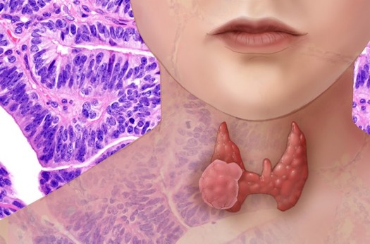 Women are much more likely to develop thyroid disorders than men, although the reasons are not well understood. (National Cancer Institute)