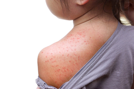The measles virus is highly contagious and can stay airborne or live on surfaces for several hours. (Adobe Stock)