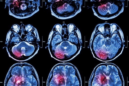 Magnetic Resonance Imaging, or MRIs, are used by physicians to diagnose and treat the symptoms of a stroke. (stockdevil/Adobe Stock)