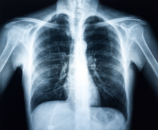 A 2021 study by researchers at the University of Illinois Chicago found financial conflicts of interest among doctors reviewing the chest X-rays of coal miners who filed workers' compensation claims. (Adobe Stock) 