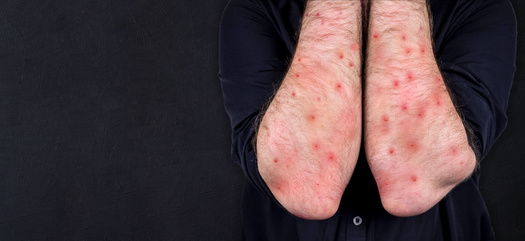 The vast majority of monkeypox cases in Washington are in the western part of the state. (Hit Stop Media/Adobe Stock)
