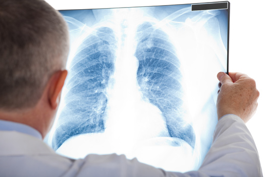 State health officials say lung cancer is the second most diagnosed cancer in both men and women in Minnesota. (Adobe Stock)
