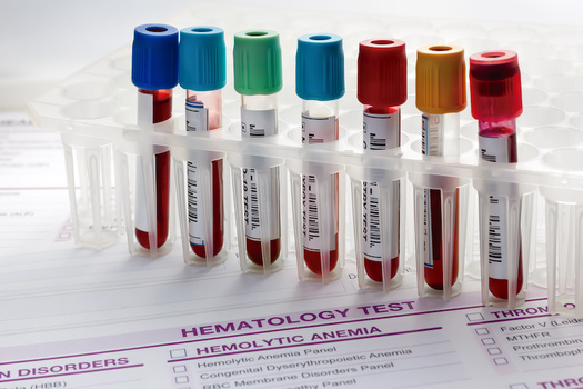 Cancer care costs are expected to top more than $245 billion by 2030, according to the American Association for Cancer Research. (Adobe Stock)