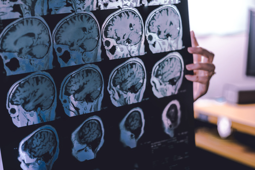 Early diagnosis of Alzheimer's saves costs of medical and long-term care, both for families and the U.S. government, according to the Alzheimer's Association. (Adobe Stock)
