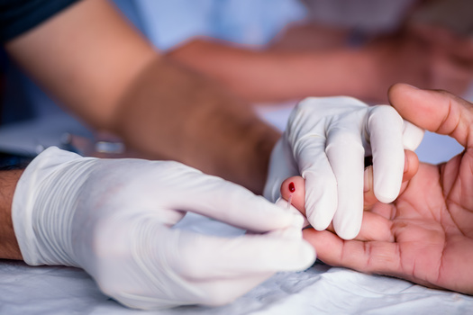 En un informe de 2020, los Centros para el Control y la Prevencin de Enfermedades dijeron que los Hoosiers enfrentarn un costo promedio de por vida de $510,000 para tratar su infeccin por VIH.  (Adobe Stock)