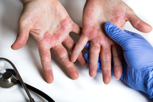 The National Eczema Association estimates one in 10 individuals will develop eczema during their lifetime, with prevalence peaking in early childhood. (Adobe Stock)