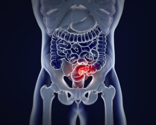 El cncer colorrectal representa una dcima parte de todos los casos de cncer en el mundo. (Anatomy Insider/Adobe Stock)