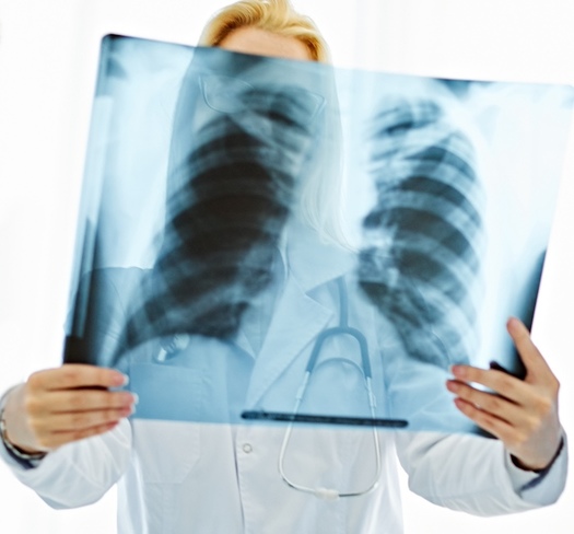 An estimated 16% of coal workers are affected by black lung disease and after decades of improvement, the number of cases of the disease is on the rise again, according to the American Lung Association. (Adobe Stock).
