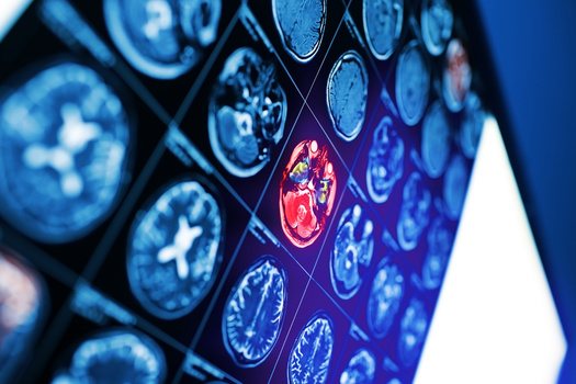 The American Heart Association cites emerging research showing in stroke care, elements of artificial intelligence-based supports reduced the chances of additional strokes by more than 25%. (Adobe Stock)