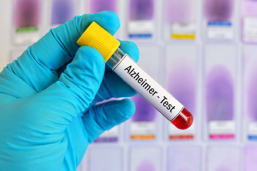 Researchers have announced a blood test they say can predict with 90% accuracy whether a patient has Alzheimer's disease. (Adobe Stock)