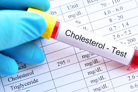 A blood test is the only way to determine your cholesterol levels.  (jarun011/Adobe Stock)