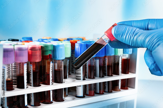 According to the American Society of Hematology, anemia, the blood clotting disorder hemophilia, and blood cancers such as leukemia, are the most common blood disorders. (Adobe Stock)