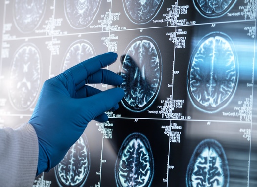 Dementia is the third-largest cause of death for individuals age 70 and older in the United States. (Adobe Stock)