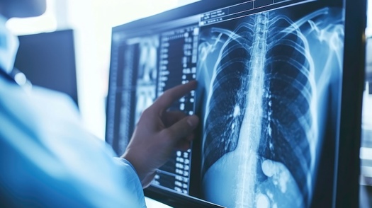 Symptoms of black lung disease can take years to develop. In early stages, the most common symptoms are cough, shortness of breath and chest tightness, according to the American Lung Association. (Adobe Stock)