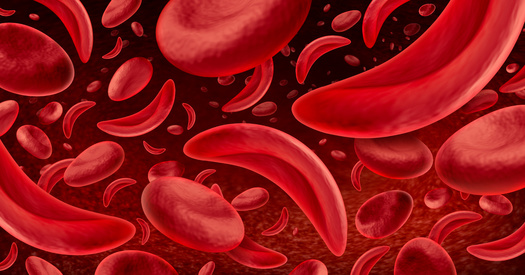 According to Innovative Hematology, Marion and Lake counties have the highest rates of sickle cell disease patients in Indiana. (Adobe Stock)