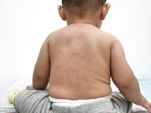 Public health officials said measles typically causes a rash, red eyes, cough and high fever and can sometimes lead to more severe health problems. (airdone/AdobeStock)