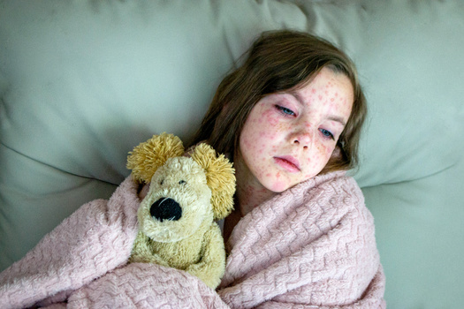 The Texas Department of State Health Services says a dose of MMR is given to unvaccinated people within 72 hours of their exposure to the measles to lessen the severity of the illness if they get sick from their exposure to the virus. (Luci/Adobe Stock)