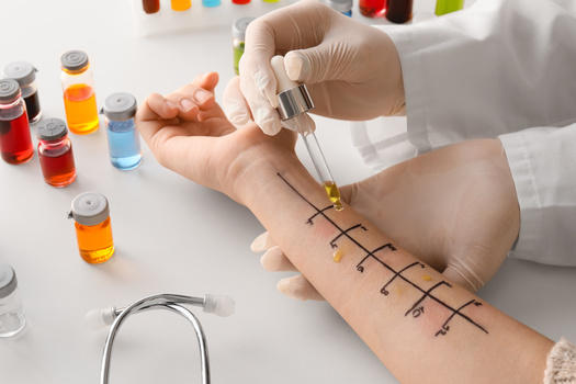 A doctor can determine what is causing allergies with skin testing or by examining your blood.(Pixel-Shot/Adobe Stock)