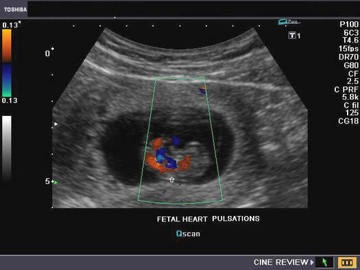 PHOTO: Baby Ultrasound. CREDIT: www.ultrasound-images.com