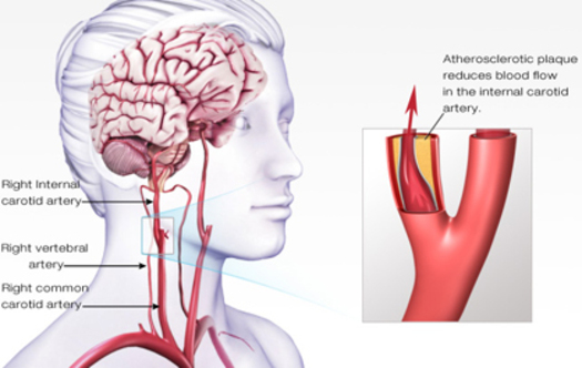 PHOTO: A diagram of an ischemic stroke. Courtesy of the American Heart Association of Minnesota.