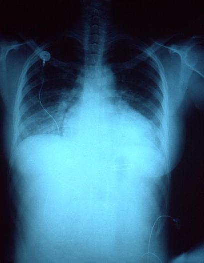 PHOTO: The x-ray of a 28-year-old woman with congestive heart failure secondary to her chronic hypertension. Heart disease is the leading killer in the United States. CREDIT: CDC/Dr. Thomas Hooten