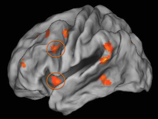 PHOTO: New research found childhood poverty impacted how much the two regions of the prefrontal cortex (as shown in orange circles) were engaged during emotion regulation. Photo:brain. Courtesy UIC.