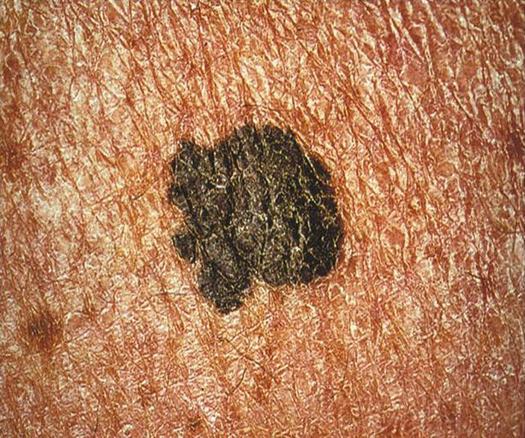 PHOTO: Melanoma is the most serious form of skin cancer. It takes the lives of around 140 Marylanders each year. May is Skin Cancer Awareness Month. Photo credit: Carl Washington, CDC.