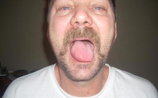 PHOTO: Randy Moyer's tongue is just one of many spots where he says he experiences unexplained pain and swelling after his exposure to fracking waste, made up of a mixture of water and toxic chemicals. Photo courtesy of Moyer.