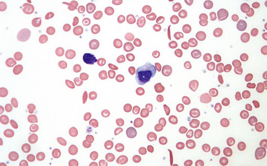 A blood smear of sickle cells that block the body's absorption of oxygen in the bloodstream. (VivCaruna/Flickr)