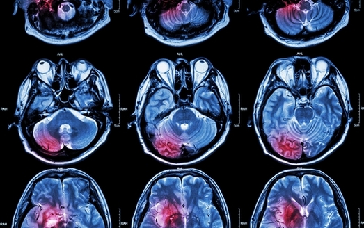 Magnetic Resonance Imaging, or MRIs, are used by physicians to diagnose and treat the symptoms of a stroke. (stockdevil/Adobe Stock)