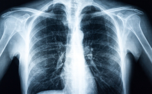 A 2021 study by researchers at the University of Illinois Chicago found financial conflicts of interest among doctors reviewing the chest X-rays of coal miners who filed workers' compensation claims. (Adobe Stock) 