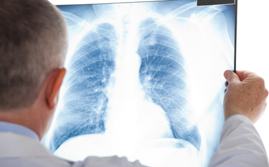 State health officials say lung cancer is the second most diagnosed cancer in both men and women in Minnesota. (Adobe Stock)