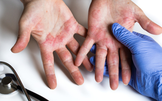 The National Eczema Association estimates one in 10 individuals will develop eczema during their lifetime, with prevalence peaking in early childhood. (Adobe Stock)