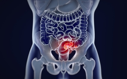 Colorectal cancer makes up one-tenth of all cancer cases worldwide. (Anatomy Insider/Adobe Stock)