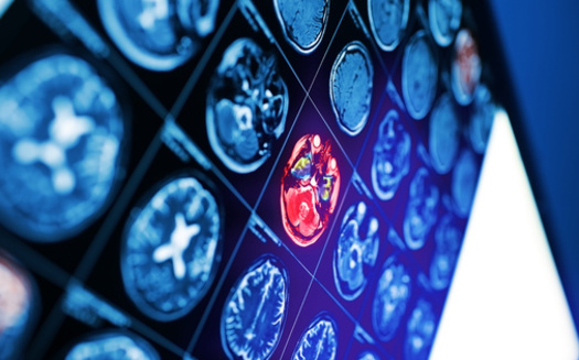 The American Heart Association cites emerging research showing in stroke care, elements of artificial intelligence-based supports reduced the chances of additional strokes by more than 25%. (Adobe Stock)