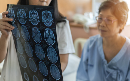 Artificial intelligence has recently been used to facilitate the diagnosis of acute stroke, by automatically detecting intracranial hemorrhage on noncontrast computed tomography scans of the head. (Adobe Stock) 
