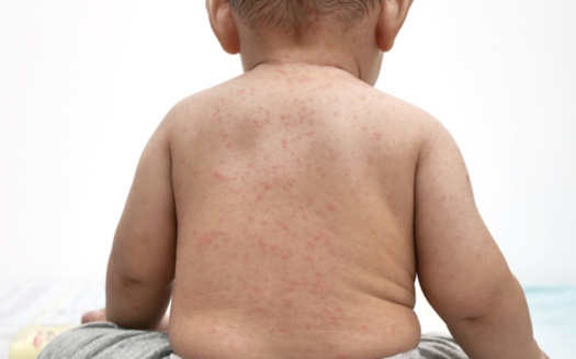 Public health officials said measles typically causes a rash, red eyes, cough and high fever and can sometimes lead to more severe health problems. (airdone/AdobeStock)
