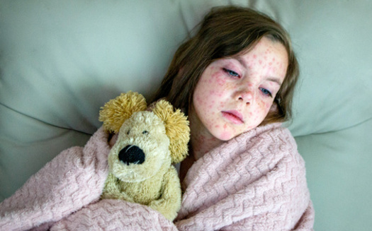 The Texas Department of State Health Services says a dose of MMR is given to unvaccinated people within 72 hours of their exposure to the measles to lessen the severity of the illness if they get sick from their exposure to the virus. (Luci/Adobe Stock)