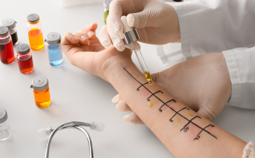 A doctor can determine what is causing allergies with skin testing or by examining your blood.<br />(Pixel-Shot/Adobe Stock)