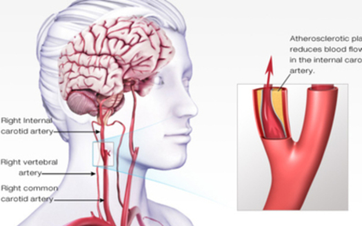 PHOTO: A diagram of an ischemic stroke. Courtesy of the American Heart Association of Minnesota.